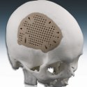 Image - PEEK plastic gains ground as titanium alternative for cranial implants