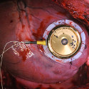 Image - Batteryless cardiac pacemaker design based on automatic wristwatch