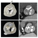 Image - 3D printing helps predict leaky heart valves