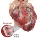 Image - Temporary wireless pacemaker dissolves in body